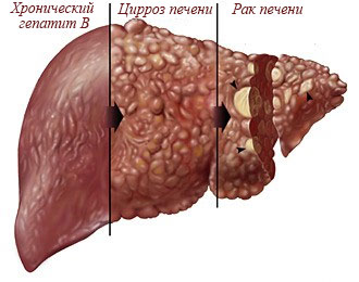 Вирусный гепатит В: что нужно знать о заболевании